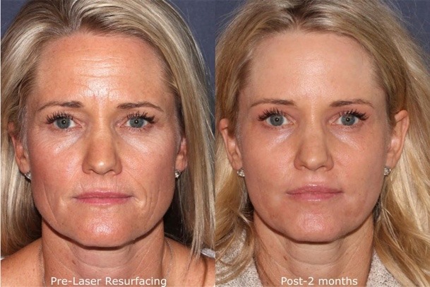 Skincare and Makeup Tips After Laser Skin Rejuvenation