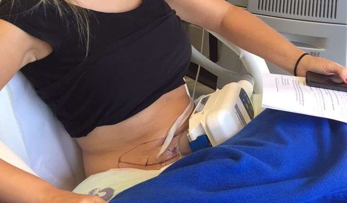 Coolsculpting for Butt Fat Removal