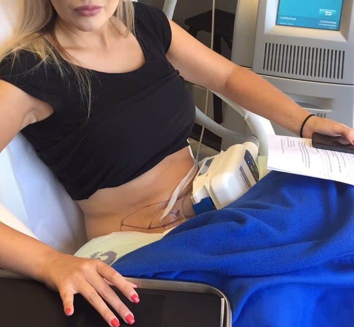 Coolsculpting for Butt Fat Removal